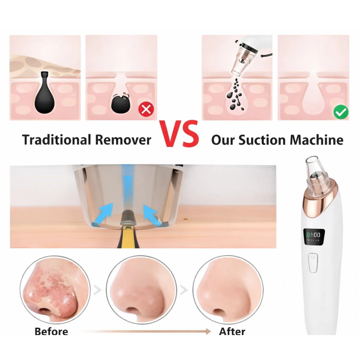 Handled Pore Vacuum Cleaner - Clear Your Pores in Minutes No Squeezing Needed