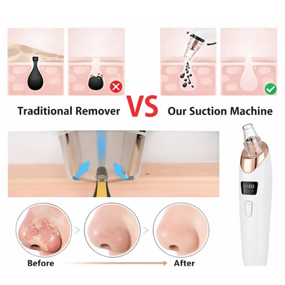 Handled Pore Vacuum Cleaner - Clear Your Pores in Minutes No Squeezing Needed